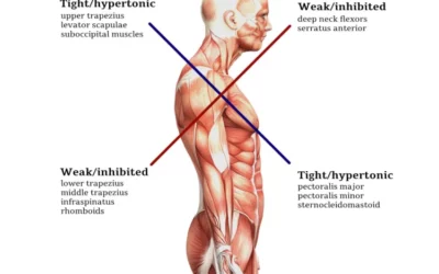 Upper Cross Syndrome