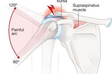 Impingement Syndrome