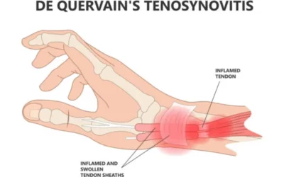 De Quervain’s Tenosynovitis