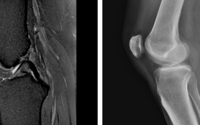 Imaging: X-Ray Vs. MRI