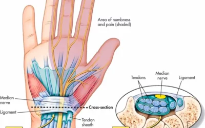 Carpal Tunnel Syndrome