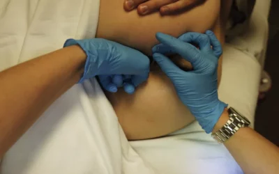 Can You Dry Needle Hip Flexors? Here’s What You Need to Know