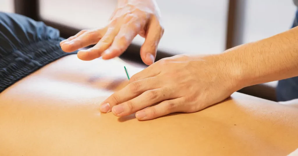 Dry Needling for Sciatica