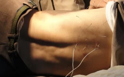 Dry Needling the Hip Flexor: What It Is, Why It Works, and How We Can Help