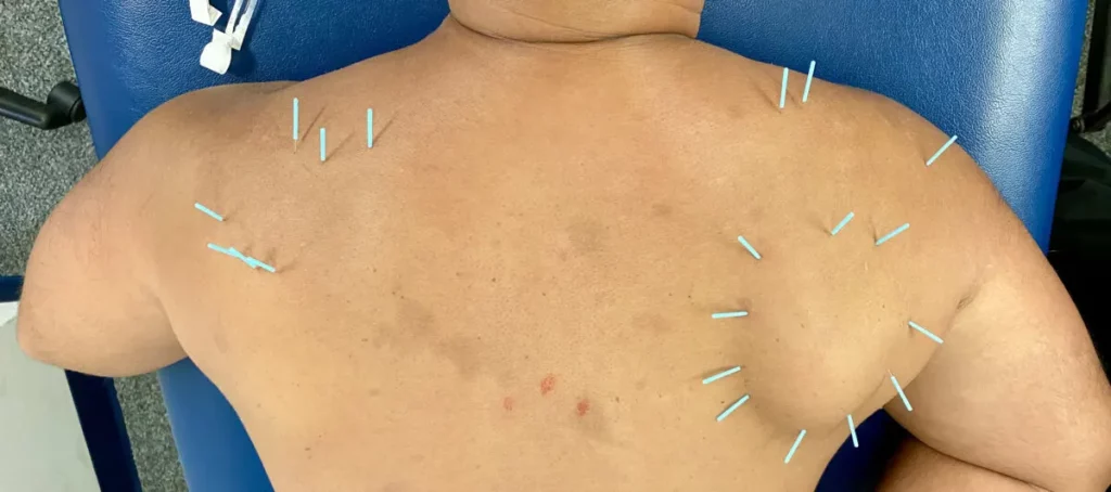 What Happens When Dry Needling Hits a Nerve