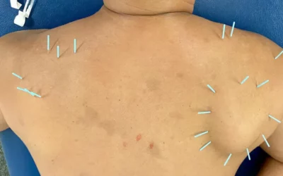 What Happens When Dry Needling Hits a Nerve?