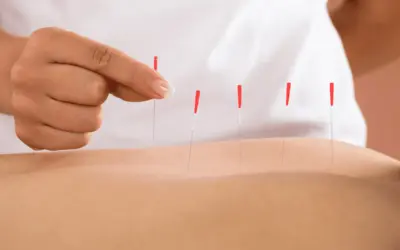 Dry Needling for Piriformis Pain: Fast-Tracking Relief